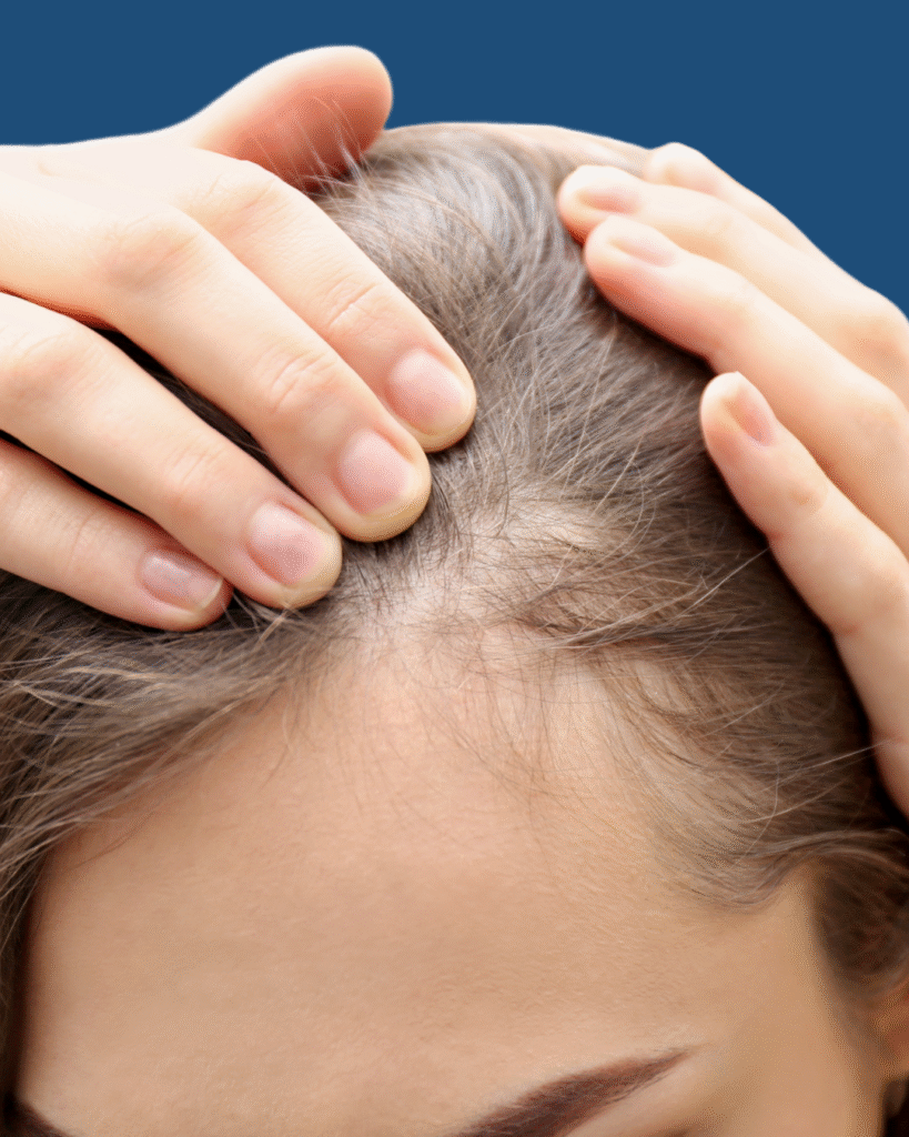 Postpartum Hair Loss