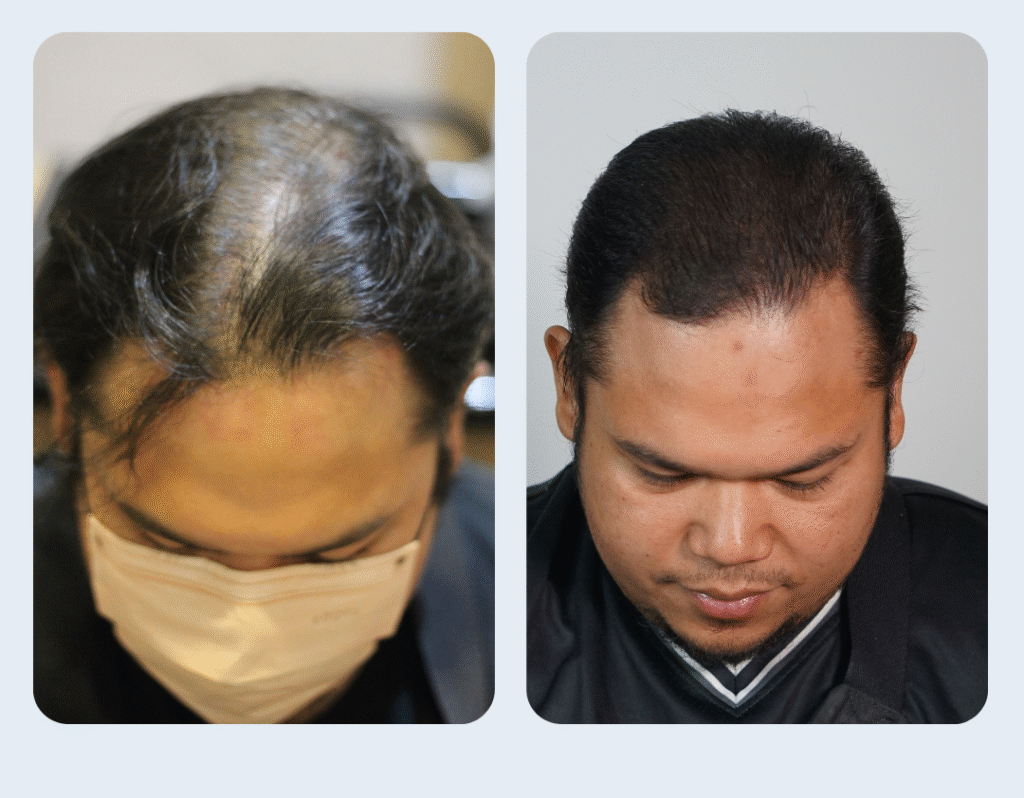 Aglow Hair Testimonials - Before / After Hazrul Aziz