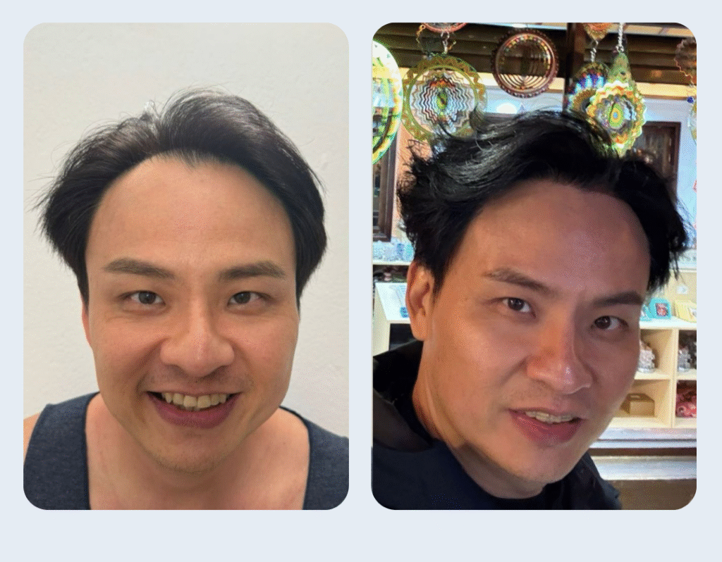 Aglow Hair Testimonials - Before / After Ken Wong